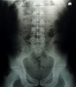 xray-of-the-spine-by-damclean.jpg