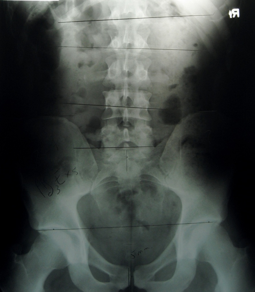 Lower Back Pain Lower Back Pain Biking
