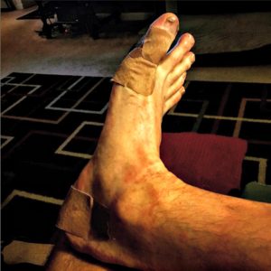ultramarathon-foot-blisters